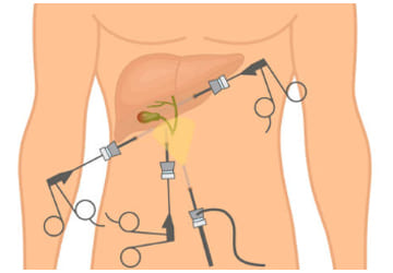 Como se realiza la extracción laparoscópica de la Vesícula Biliar